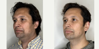35-44 year old man treated with Agnes RF, Microneedling RF - During a one-year weight loss journey, non-surgical treatments improved full-face skin tightening, reduced under-chin fat, enhanced jawline definition, and refreshed the under-eye area for natural results.