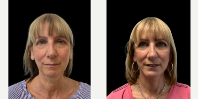 55-64 year old woman treated with Facelift, Chin Implant, SMAS Facelift, Neck Lift, Lower Facelift - Patient who has undergone a deep plane facelift, chin implant and necklift