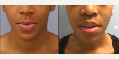 Woman treated with Lip Lift - This patient was looking to have a more feminine look to her face. I did a 10mm excision of skin to elevate the lip and make for a more delicate and feminine appearance. A surgical lip lift is a quick procedure that can be a powerful tool to bypass the need for lip fillers for patients who dont want to have to come in twice a year for injectible treatments.