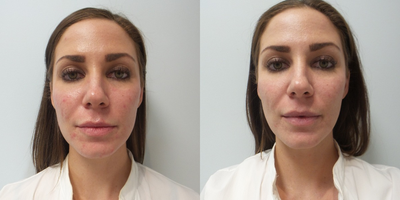 25-34 year old woman Acne Treatment with MicroBotox - Acne treated with a new technique of MicroBotox. Small amount of Botox in the superficial layer of skin to reduce the sebum production from the sebaceous glands. After photos are 8 days after treatment. No other therapy was given. No antibiotics, no topicals, no retin A or retinols. This improvement should last at least 3 months.
