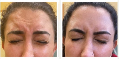 35-44 year old woman treated with Dysport - 37 year old expressive woman before and after Dysport injections to the classic 3 muscles of the face:  11 lines, forehead and crow's feet.More symmetric, arched brows, rested face and open-eyed smile....and of course future wrinkle prevention!