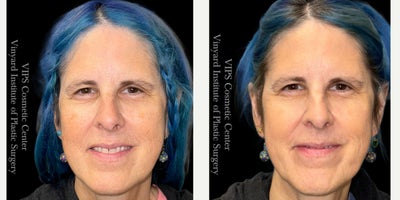 55-64 year old woman treated with Skin Lightening, Skin Rejuvenation, IPL - This patient was looking to enhance her skins radiance and address concerns like uneven tone, fine lines, and dullness. With just one session of the Elluminate Advanced Photofacial, she achieved a brighter, smoother, and more even complexion. This cutting-edge treatment worked to rejuvenate multiple layers of her skin, targeting redness, hyperpigmentation, and texture irregularities. The result? A naturally refreshed and youthful glow that has left her feeling confident and revitalizedall with little to no downtime.