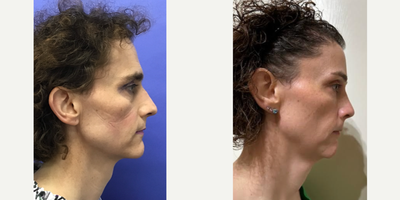 Patient treated with Voluma, Juvederm, Cheek Augmentation - 2cc Voluma to Cheeks - 35 to 44 year-old female patient is 1 year post-op from Facial Feminization surgery. Her procedures included: Forehead Lift and Orbital Bony Contouring, Septorhinoplasty (closed) with Cartilage Grafts and Weirs, Chin Reduction and Contour, Soft Tissue to Nasolabial Folds, Intranasal Lip Lift with Fascia to Lips, Thyroid Cartilage Shave and Voice Feminization, 2cc Voluma to Cheeks, and 400 Micrografts to Recessions.