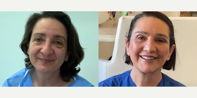 50 year old woman treated with Facial Fat Transfer - 50 year old woman treated with Facial Fat Transfer as well asDeep Plane Facelift,Neck Lift, Eyelid Surgery, Rhinoplasty, and Facial Fat Transfer, shown 3 years post op.