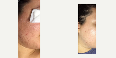 18-24 year old woman treated with Aerolase - Before and after progress. Patient has had a total of 5 Aerolase treatments - 1 treatment, 1 week apart.