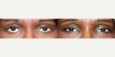 Reducing scleral show from lower eyelid retraction - When lower eyelid surgery complications bring down the eyelids, the often expose more of the sclera or the white of the eyes, also called scleral show. Lower eyelid retraction is commonly caused by unnecessary removal of lower eyelid skin, and is more likely to be caused by the transcutaneous approach of lower eyelid surgery where the incision made to remove fat that causes eye bags can also compromise lower eyelid support anatomy. It is also important to note that the transcutaneous approach is not recommended on darker skinned patients, as the external incision is more likely to cause scarring in darker skinned patients. Raising the lower eyelids through specialized anchoring and grafting by eyelid specialists can reduce scleral show, and give eyes a more expressive look, rather than the sad weariness of pulled down eyelids.