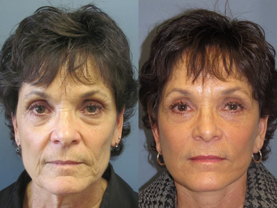 Obagi Blue Peel - 	Blue Peel by Obagi is chemical peel to help achieve firmer smoother skin. Notice a peel with The Lite Lift allows refreshed skin to now have that wow appearance.This 62 y/o has a flawless glow .Dr .Horowitz uses a Blue peel to maximize the results of Lite Lift depending on patients desires.