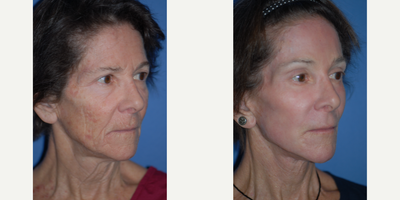 Woman treated with Facelift - Woman treated with Facelift as well as CO2 Laser for wrinkle removal