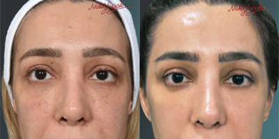 25-34 Years Old Woman Treated with PicoSure - As a result of Pico Laser treatment; the final state of our patient; whose skin has been renewed.
