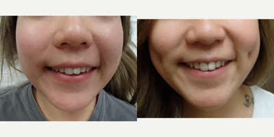 25-34 year old woman treated with Dimple Surgery - Timeless Dimple, Dimple Creation