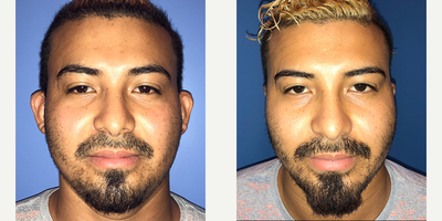 Man treated with Ear Surgery - Man treated with Ear Surgery