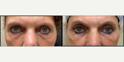 45-54 year old woman treated with Revanesse - Tear trough and cheek blend filler to improve under eye hollows