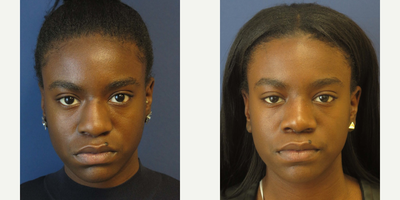 African American Rhinoplasty - Primary Rhinoplasty, African American, Open Approach
