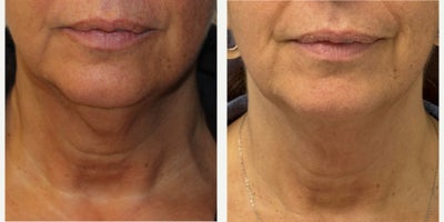 Woman treated with Microneedling, Microneedling RF - Woman treated with Microneedling, Microneedling RF