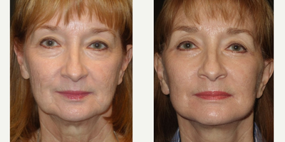 55-64 year old woman treated with Lifestyle Lift - Face lift; lower eyelid surgery