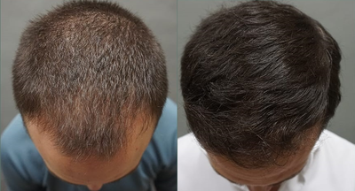 Man treated with Hair Transplant - Man treated with Hair Transplant