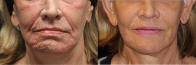 65-74 year old woman treated with Non Surgical Face Lift - This patient came to see Dr. Mark Anton in Newport Beach because she wanted to refresh her face without having surgery. Dr. Anton recommended that she do a series of radio frequency treatments and fillers in the office to rejuvenate her face. Over the coarse of year she had a series of different radio frequency treatments with the InMode platform. She had multiple sessions of Fractora; radio frequency delivered through microneedling to resurface the skin and rebuild the collagen fibers. She also had multiple sessions of Lumecca; the newest generation of IPL technology to correct her pigment issues and to rejuvenate the skin cells at the DNA level. She also completed a Forma series; radio frequency delivered through heat to tighten and smooth the skin with no downtime. She also had multiples injections of fillers: Belotero, Juvderm Plus, Sculptra, and Vollure to fill out her deep wrinkles, hollows, and loss of contours. She was compliant with following through on each series and saw tremendous results after a year of treatments.