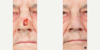 Man treated with Mohs Surgery - Mohs Reconstruction: Restoring Beauty and Health after Skin Cancer ResectionOur latest success story showcases the remarkable transformation of this sweet woman who was diagnosed with basal cell carcinoma on her left nasal tip.Cancer can be an overwhelming adversary, impacting not only ones health but also self-confidence and appearance. Once removed and cured, the defect can be emotionally devastating. This case highlights the dual challenges faced by our patient.Utilizing the advanced technique of Mohs reconstruction, our dermatology colleagues delicately removed the cancerous tissue while preserving as much healthy skin as possible. Her preference was the quickest recovery with the least amount of at-home care. Sometimes a paramedian forehead flap can be used for these with excellent results, but it comes at a cost of 2-3 stages of reconstruction. Instead, we were able to reconstruct the nose with local skin flaps in the office, ensuring long-lasting results and minimal downtime.