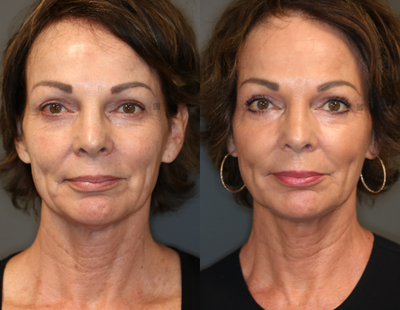 Non Surgical Rejuvenation - Filler, neck tightening and laser.