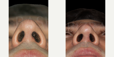 Patient treated with Sinus Surgery - Blocked Nose