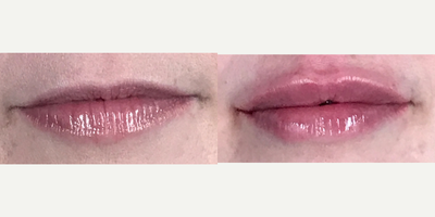 35-44 year old woman treated with Restylane Defyne in Lips - 35-44 year old woman treated with Restylane Defyne in Lips