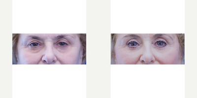 65-74 year old woman treated with Fat Transfer - This upbeat, positive, genuine lady does not want to appear tired without energy. She undergoes upper and lower eyelid rejuvenation and fat transfer to cheek. Excess upper eyelid skin and protruding lower eyelid fat are reduced in this procedure as well.