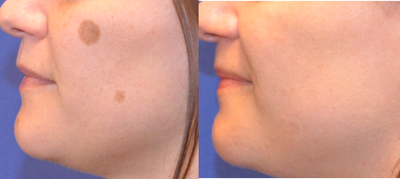 25-34 year old woman treated with GentleLase - This patient had two pigmented lesions on her left cheek. Five separate Gentlemax treatments were performed over a few months and the results are amazing.&nbsp;