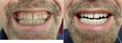 Zoom! Laser Whitening - 
	4 x 15 minute sessions of Zoom! whitening. Like most of our patients the patient experienced no sensitivity.
