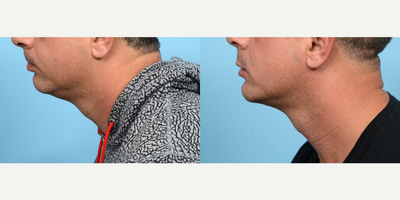 35-44 year old man treated with Chin Surgery - In order to achieve the chiseled jawline of this patient's dreams, Dr. Wise performed a combination of chin implant and submental liposuction procedures.