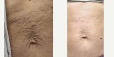 55-64 year old woman treated with Morpheus8 - Stomach - treated by Alyssa G