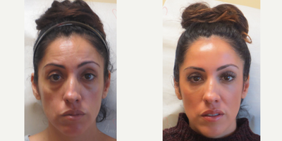 Woman treated with Liquid Facelift (Botox, Restylane & Voluma) - Botox injection in in forehead and between eyebrows; Restylane injection under the eyes, Juvederm Voluma injection in the cheeks performed by flexcible micro-cannula.