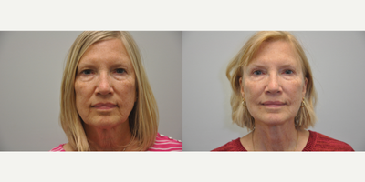 63 year old female treated with Eyelid Surgery - 63 year old woman 4 months following treatment with Facelift, Necklift, Facial Fat Grafting, and upper Blepharoplasty