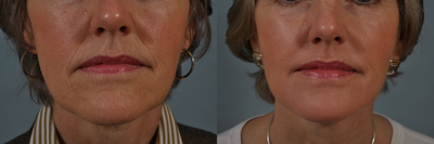Around the mount Hetter Peel - 
	Patient underwent a Hetter Peel of the Peri-Oral area.
