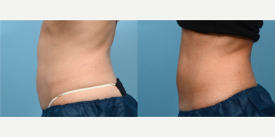 45-54 year old woman treated with Cryolipolysis - One session of CoolSculpting at Wise Med Spa was all it took to give this patient the definition she was looking for in her abdomen. Three months post-treatment, she couldn't be happier with her slimmer appearance!