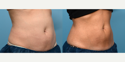 45-54 year old woman treated with Cryolipolysis - One session of CoolSculpting at Wise Med Spa was all it took to give this patient the definition she was looking for in her abdomen. Three months post-treatment, she couldn't be happier with her slimmer appearance!