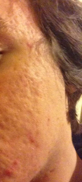 Can I ever get rid of my acne scars completely? Or will I ...