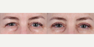 Woman treated with Double Eyelid Surgery - Woman treated with Double Eyelid Surgery