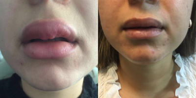 35-44 year old woman treated with Silicone Injection Removal - Under local anesthesia we performed an upper lip reduction after PMMA injections received 8 years ago. a very simole ambulatory procedure.