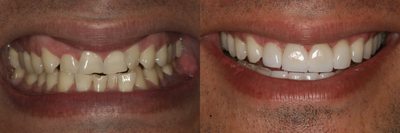 42 Year old Male - 42 year old Male wanting to get a straighter more even smile. This patient did Invisalign and after Invisalign whitened with upper four veneers.