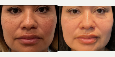 25-34 year old woman treated with Chemical Peel - Melanage Peel By Christine in Austin TX