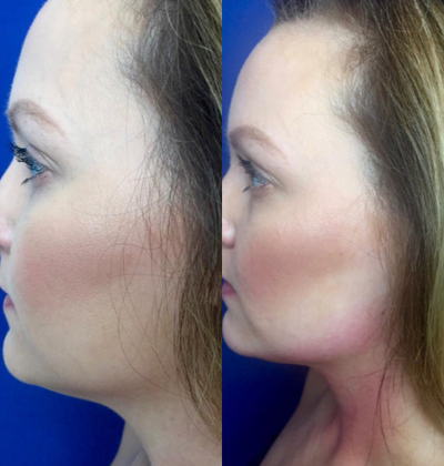 25-34 year old woman treated with Forma - Before and after Forma Treatment