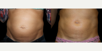 Emsculpt - Photo provided courtesy of BTL Industries, Inc., performed by Paula Lozanova