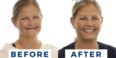 45-54 year old woman treated with All-on-4 Dental Implants - You can get permanent, lasting teeth in 24 hours at Nuvia. Avoid waiting up to 10+ months for final teeth like traditional methods require.