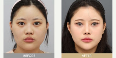 18-24 year old woman treated with Cheekbone Reduction - Facial Contouring