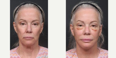 65-74 year old woman treated with Deep Plane Facelift, Facelift Revision, Facial Fat Transfer, Eyelid Surgery - Facelift RevisionNeck liftFat GraftSubmentoplastyLower Blepharoplasty Revision