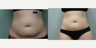 35-44 year old woman treated with Mesotherapy - Mesotherapy | Stomach
