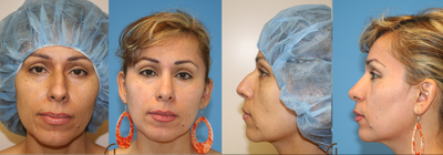 Nose job or Rhinoplasty - 
	This patient was unhappy with her bump on nasal bone. Performed an open rhinoplasty to improve the shape of her nose.&nbsp;
