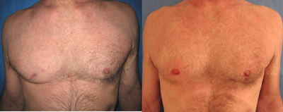 55-64 year old man treated with Nipple Surgery - 62-year-old man with recurrent basal cell carcinoma of his right nipple who underwent right nipple reconstruction