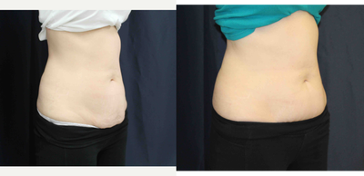 53 y/o female treated with SculpSure on her lower abdomen - This patient had two treatments of Sculpsure on her lower abdomen. She has also been using our Skinceuticals Body Tightening Concentrate Serum on her lower abdomen to tighten the skin. The pictures below are after 2 treatments, 13 weeks apart.&nbsp;