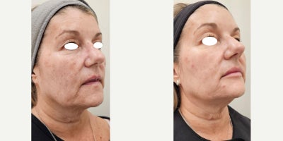 55-64 year old woman treated with IPL, Sylfirm X, Lip Fillers, Ultherapy, Alastin Skincare, Dysport - She started her Beauty Journey on January 31st 2024. She wanted to improve her skin quality in a natural and less invasive way. Her neck was a priority.We started with Ultherapy, 3 combined lasers (IPL plus vascular), Dysport, lip filler and then 3 SylfirmX face and neck treatments. She is using Alastin skincare